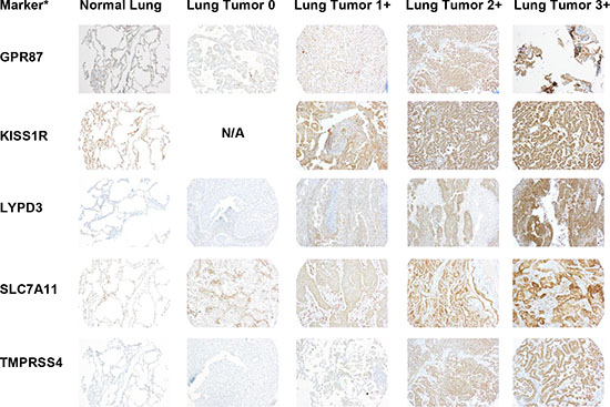 Representative images of IHC stained patient lung tumor and normal lung tissue specimens from the tissue microarray (TMA) for the remaining selected markers.