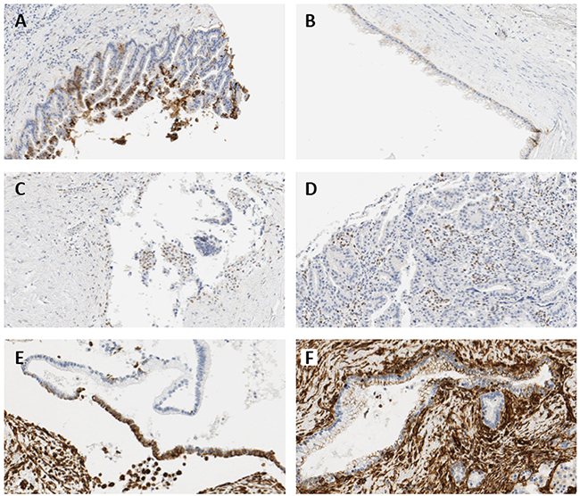 Representative immunohistochemical images showing expressions of E-cadherin and ZEB1.