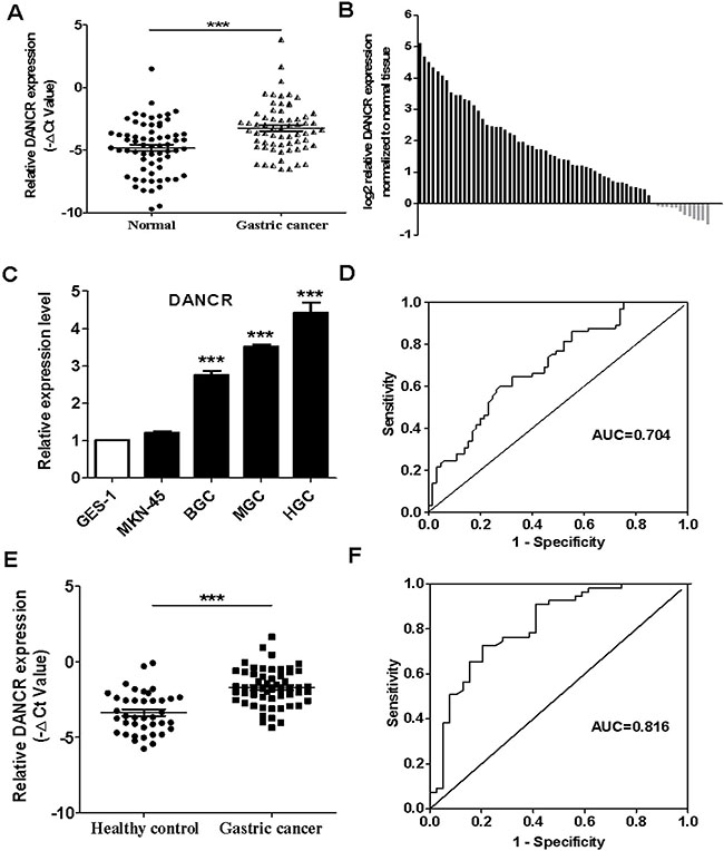 The relative expression levels of DANCR in the tumor tissues and serum samples of gastric cancer patients and gastric cancer cell lines.