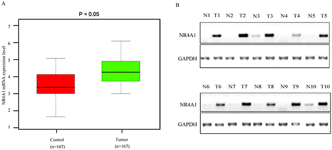NR4A1 mRNA and protein expression level in NSCLC carcinoma tissues and the matched para-carcinoma control tissues.