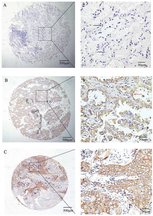 Representative IHC stainning showed NR4A1expression in NSCLC tissues.