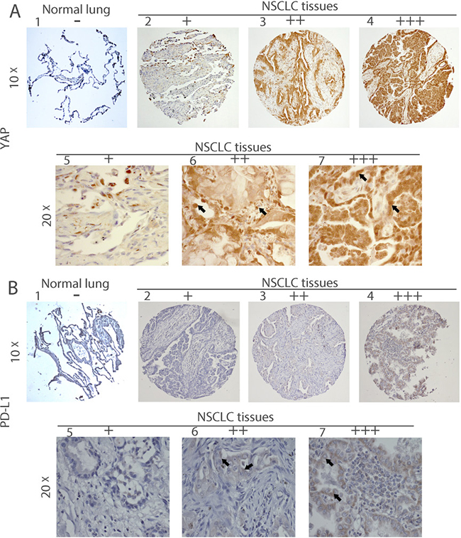 Immunohistochemistry of YAP and PD-L1 in human NSCLC tissues.