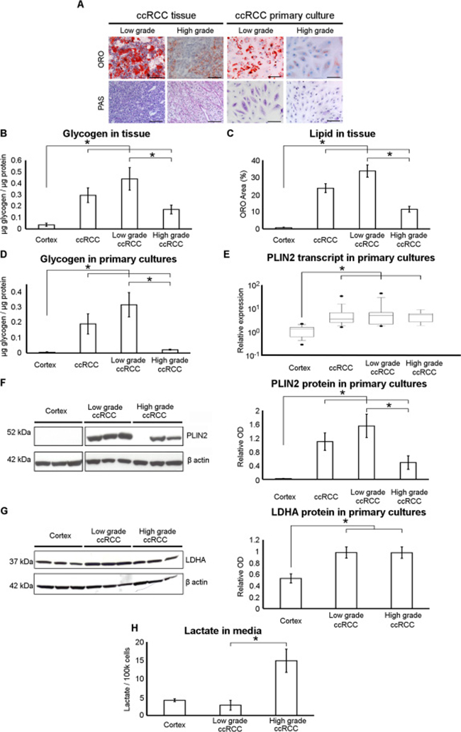 Neutral lipid and glycogen storage is decreased and lactate production increased in high-grade ccRCC primary cultures.
