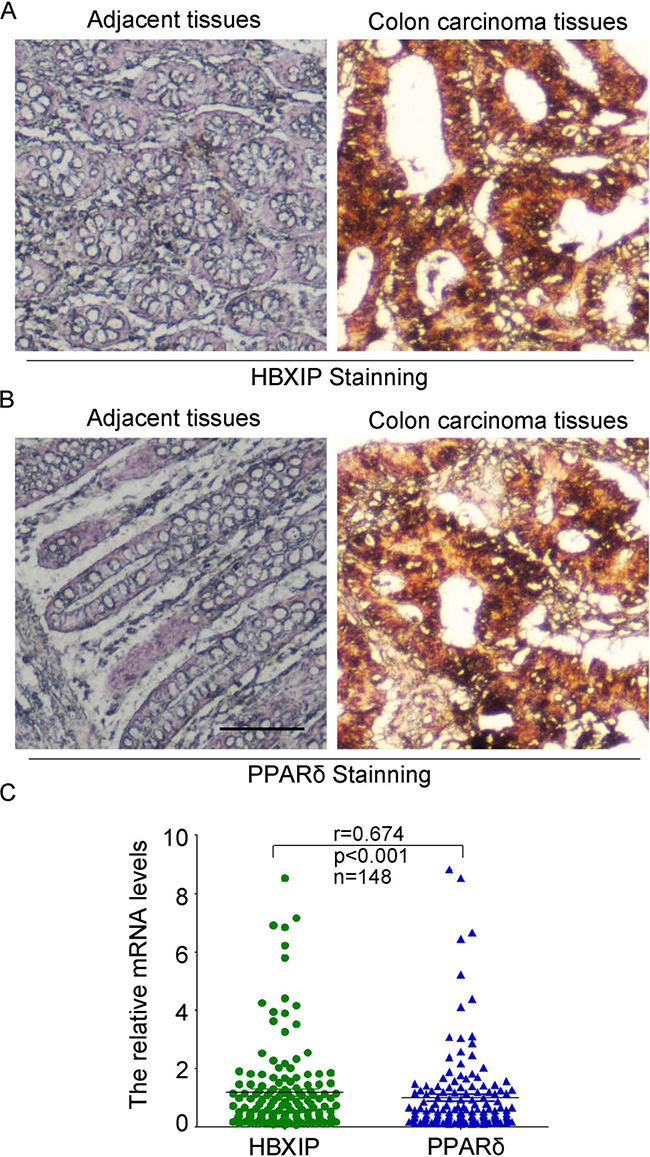 HBXIP has a significant positive correlation with PPAR&#x03B4; in clinical colonic carcinoma tissues.