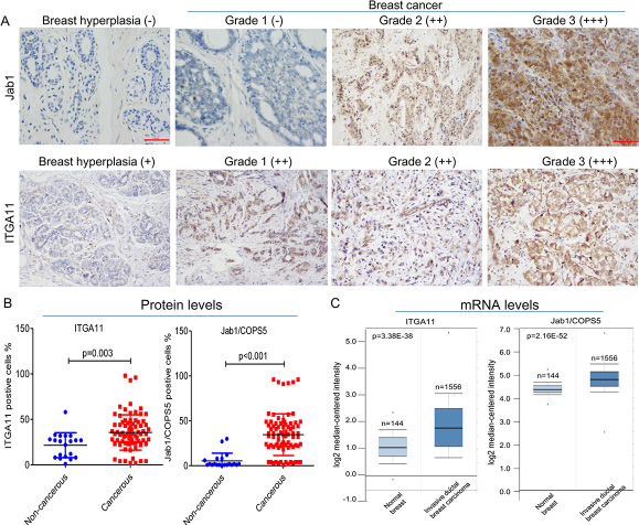 IGTA11 and Jab1 expressed in breast cancer.