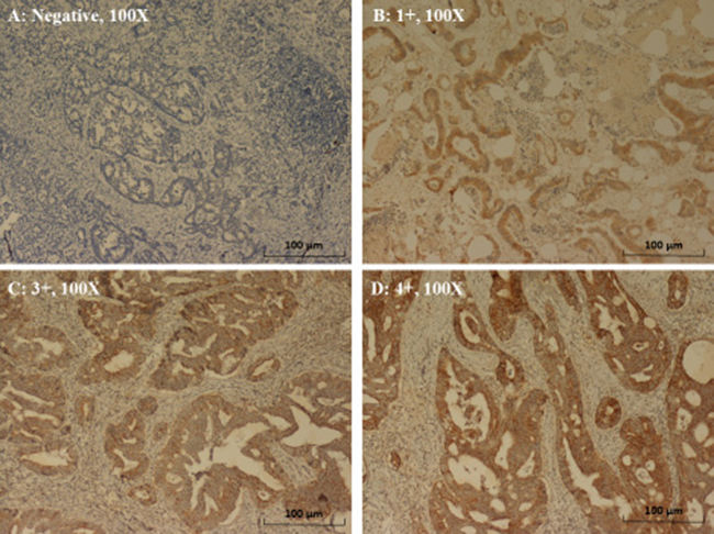 Immunohistochemical staining of EGFR in CRC.