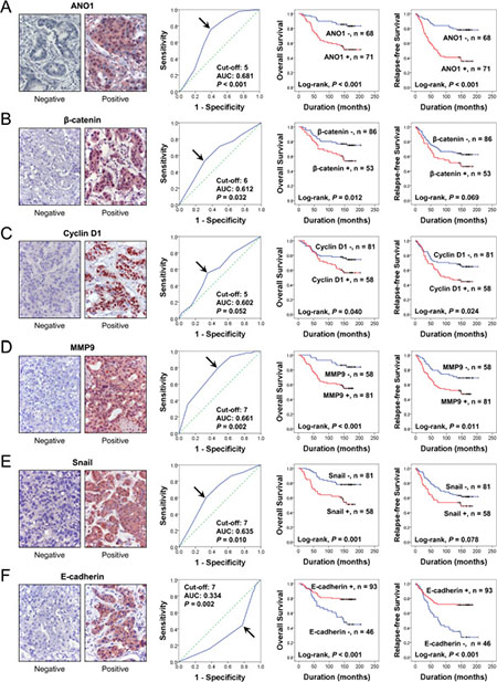 Expression and prognostic significance of ANO1, &#x03B2;-catenin, cyclin D1, MMP9, snail, and E-cadherin in 139 human breast carcinomas.