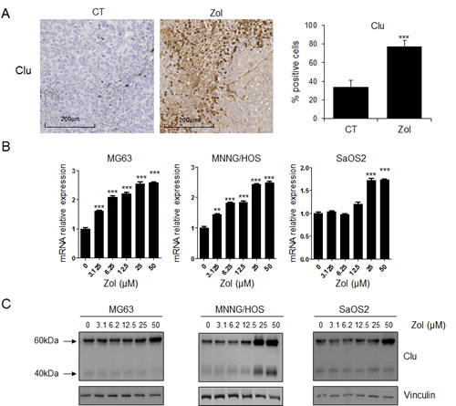 ZOL induces CLU expression in osteosarcoma in vitro and in vivo.
