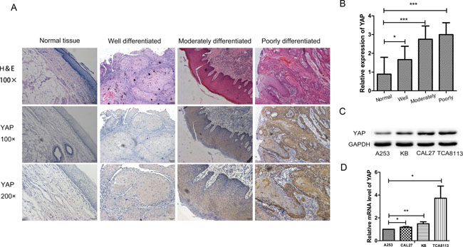 YAP was highly expressed in oral squamous cell carcinoma.