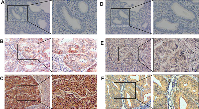 PGK1 and GRP78 expression in endometrial carcinoma and normal endometrial tissues were examined by immunohistochemistry.
