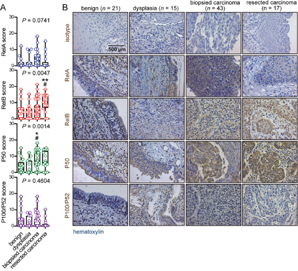 Immunohistochemical detection of NF-&kappa;B subunit expression by clinicopathologic study group.