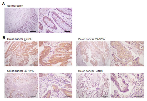 Expression of TM4SF5 in colon cancer tissues.