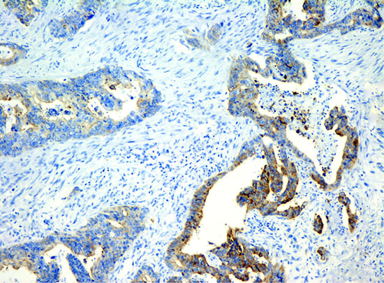 The heterogeneous expression of Lgr5 at at tumor margin and tumor center in CRC.