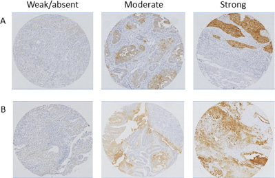 Representative examples of FR&#x03B1; expression status in endometrioid and clear cell EC.