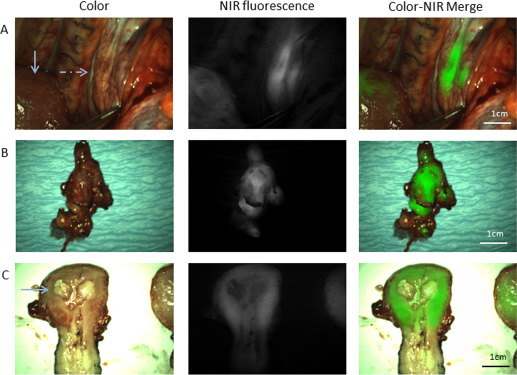 Fluorescence imaging of a primary uterine serous adenocarcinoma and of the metastatic lymph nodes.