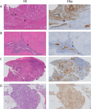 Histopathological evaluation of resected lesions.