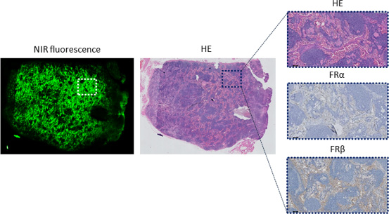 Histopathological evaluation of a false-positive lymph node.