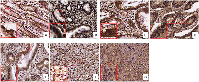 FZD-10 expression in dysplastic and tumor gastric tissues.