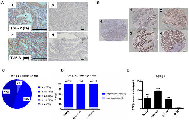 Expression of TGF-&#x03B2;1 in normal endometrial and EC cells.