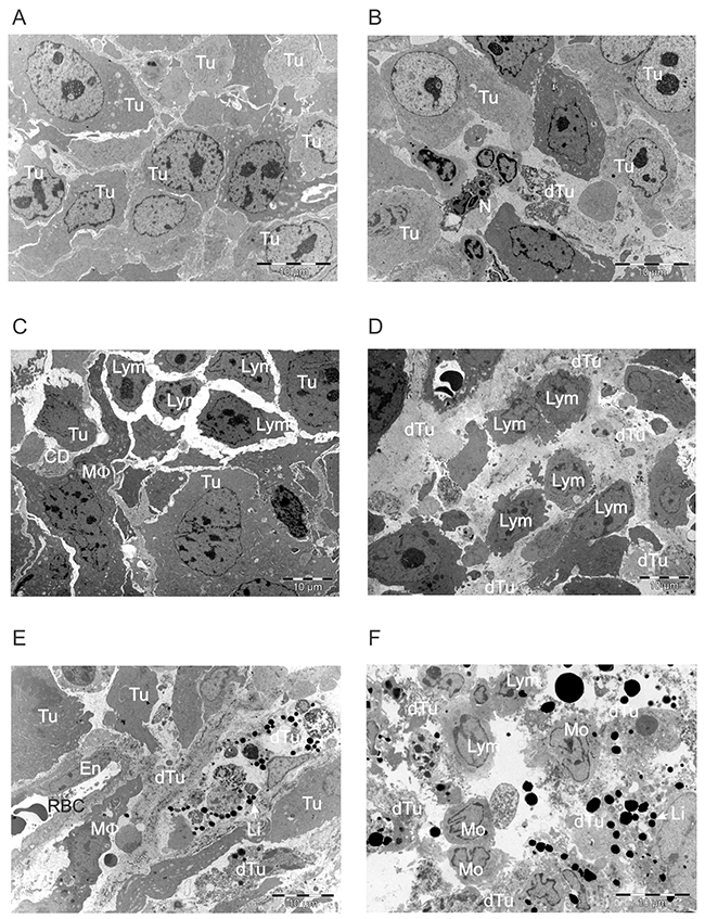 ACTIV therapy induces progressive tumor cell death and increased leukocyte infiltration over time.