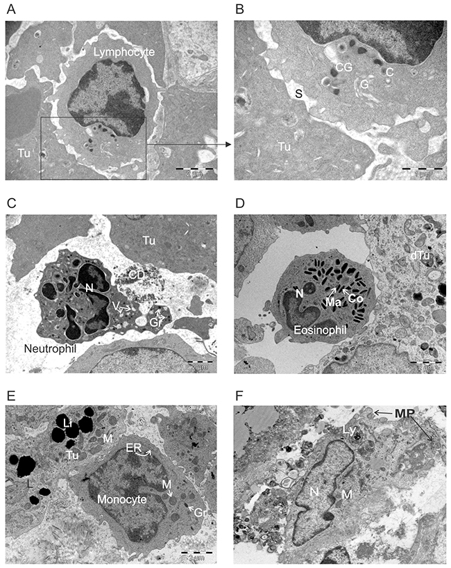 Ultrastructural appearance of leukocytes infiltrating ACTIV-treated tumors.
