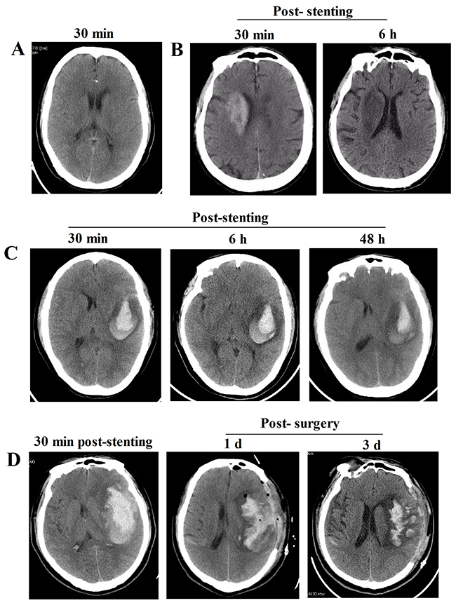 Representative images of the CT features in three Types after intracranial artery stenting.