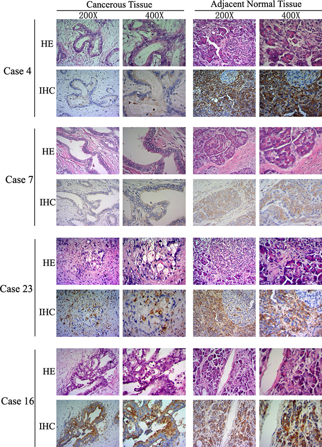 LITAF protein expression in human pancreatic cancer.