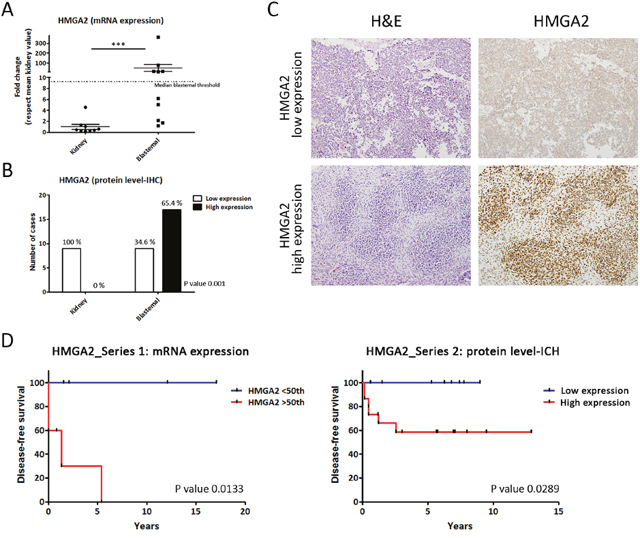 Differential HMGA2 expression distinguishes two types of blastemal WT component.