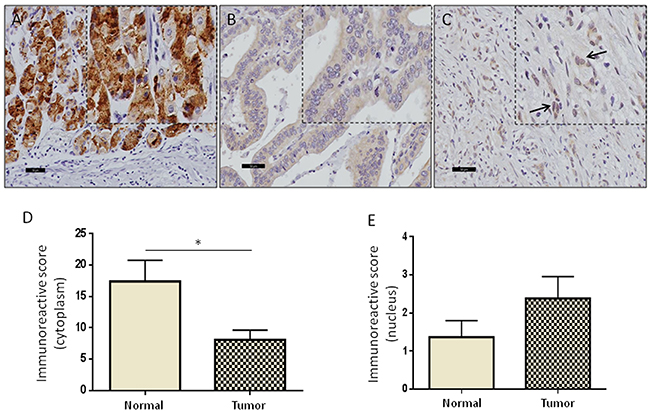 High levels of nuclear GRAMD1B are associated with aggressive diffuse-type of gastric cancer.
