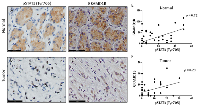 GRAMD1B expression pattern shows a positive correlation with pSTAT3 (Tyr705) in gastric tissue.