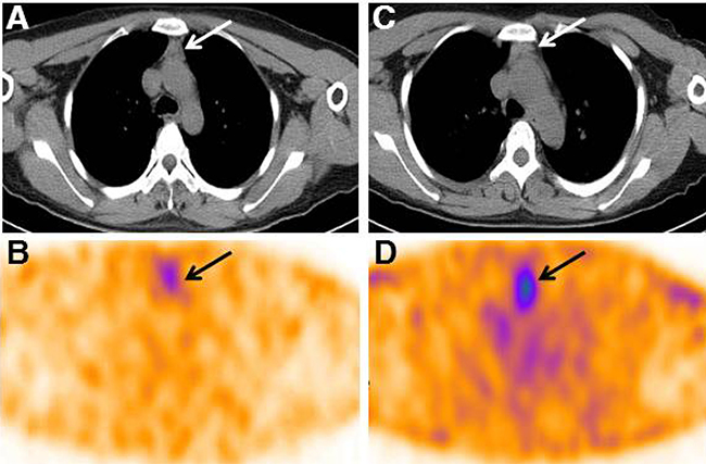 Two representative 99mTc-3PRGD2 SPECT/CT images of TENIS patients with different serum Tg levels.
