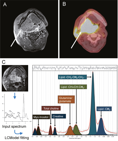 A 54-year-old man with right tonsillar squamous cell carcinoma.