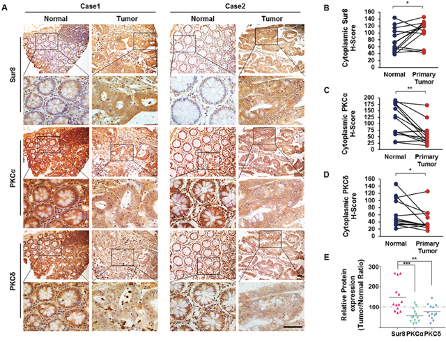 Expression of Sur8, PKC&#x03B1;, and PKC&#x03B4; protein in human colorectal normal vs. tumor paired tissues.