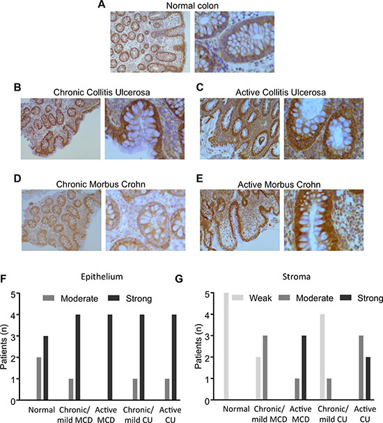 DDX3 expression in colon biopsies.