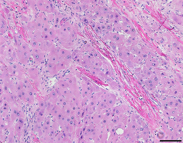 Hematoxylin and eosin stained FLC tumor tissue showing large polygonal cells with vesiculated nuclei, large nucleoli and intratumoral lamellar bands of collagen.