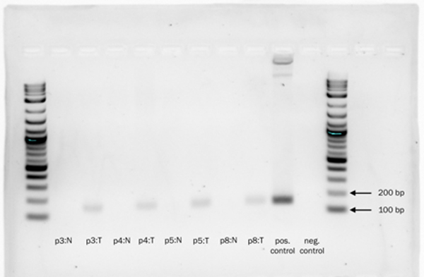 2% agarose gel demonstrating the presence of the DNAJB1-PRKACA chimeric transcript in tumor tissues (T = tumor), but not in adjacent normal liver samples (N = Normal).