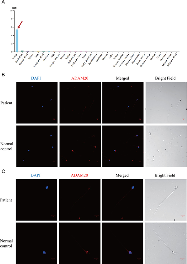 The expression pattern of ADAM20 changed in the patient&#x2019;s spermatozoa.