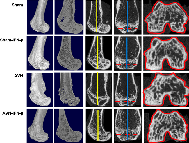 Representative micro-CT scan images of infarcted distal femurs in the sham-control, sham-IFN-&#x03B2;, AVN, and AVN- IFN-&#x03B2; groups.