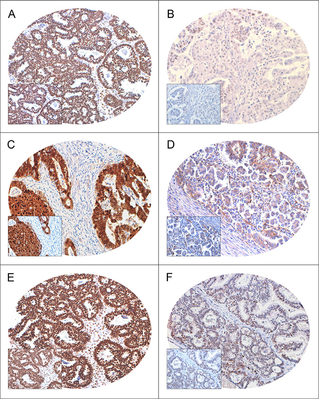 Immunohistochemical analysis of FoxM1, &#x03B2;-catenin and TCF4 expression in Epithelial Ovarian Cancer (EOC) TMA (n = 261).