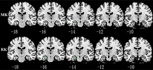 Representative coronal images show increased MK and RK in parahippocampus (p &#x003C; 0.001, with a minimum cluster size 10) in KIBRA C-allele carriers compared with TT carriers.