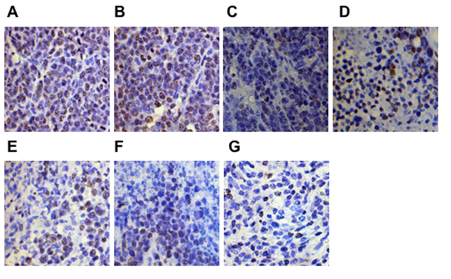 Ki-67 expression detected in tumor tissues by immunohistochemical staining (&times;400).