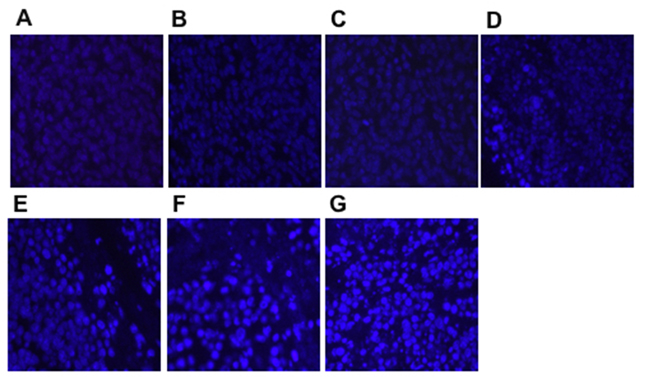 Apoptosis in tumor tissues detected by Hochest staining (&times;400).