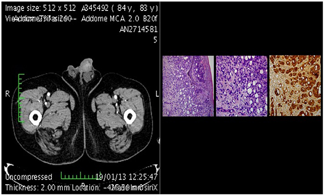 CT-scan of metastasis plus histological section.