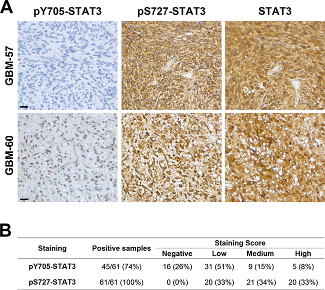 STAT3 is preferentially activated by pS727 in GBM clinical samples.