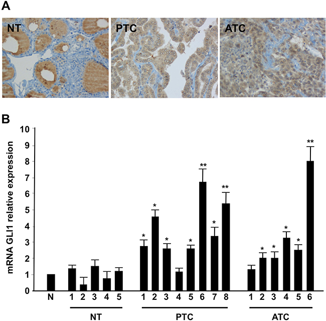 Shh signaling components are up-regulated in thyroid tumors.