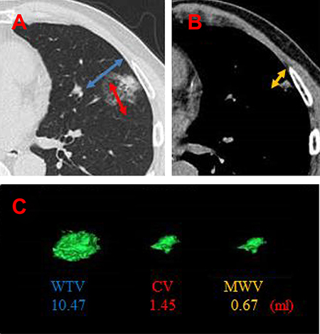 Three-dimensional reconstructed images of a representative pulmonary adenocarcinoma.