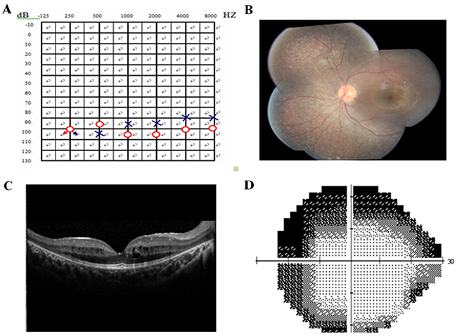 Pure tone audiogram, fundus photography, optical coherence tomography (OCT), and visual field of the proband.