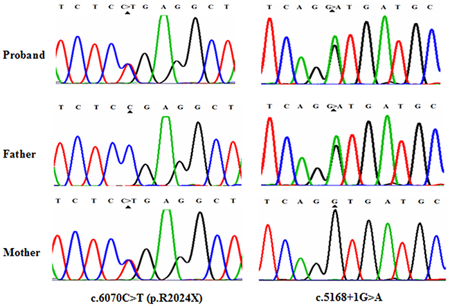 Mutational analysis of MYO7A in USHI family.