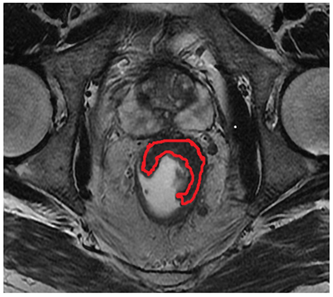 The region delineated by red curved line indicates indicates the measurement of maximum tumor area(MTA) on the oblique axial T2-weighted imaging.