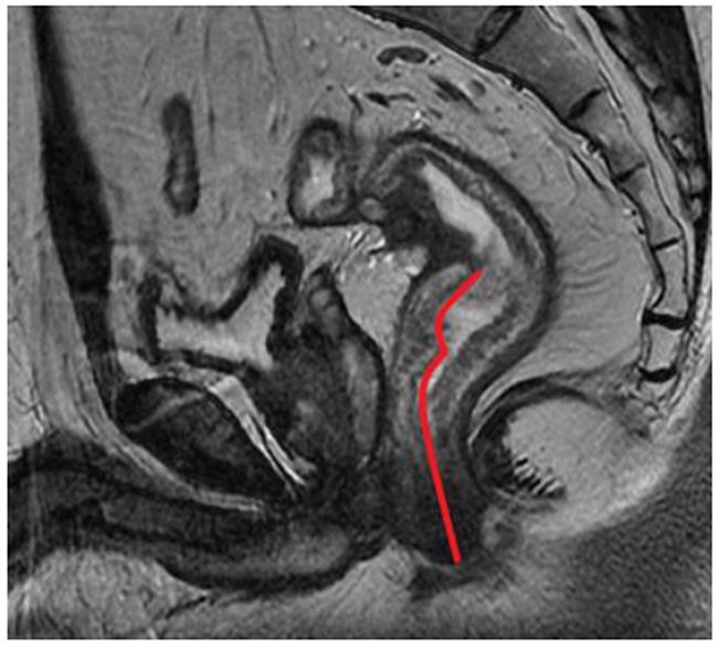 The red curved line from from the inferior part of the tumor to the anal verge indicates the measurement of distance from tumor to anal verge (DTA) on sagittal T2-weighted imaging.